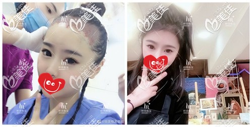 發(fā)際線種植前后對比照片