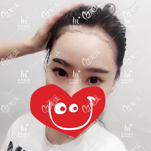 發(fā)際線種植術(shù)前照片