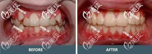 隱形牙套適合虎牙外突嗎？案例證明選擇用隱適美矯正的效果很喜人~