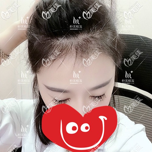發(fā)際線種植5個(gè)月效果
