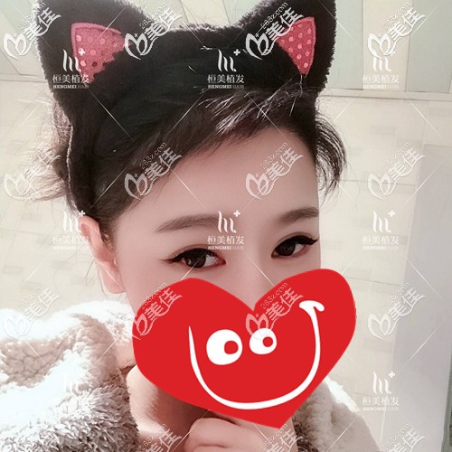 頭發(fā)種植后太可怕了后悔了...自己怎么沒能早點(diǎn)來(lái)成都恒美做植發(fā)呢?