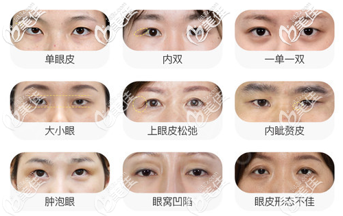 深圳富華金順女醫(yī)生擅長(zhǎng)各種類型雙眼皮