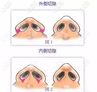 縮鼻翼外切和內(nèi)切切口區(qū)別對(duì)比圖