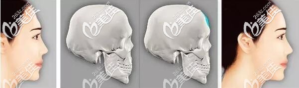 玻尿酸豐額頭 玻尿酸豐額頭