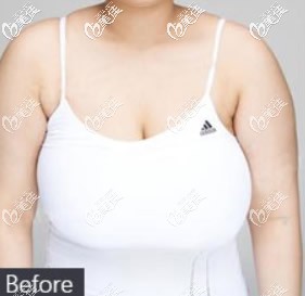 二次縮胸手術(shù)前的照片