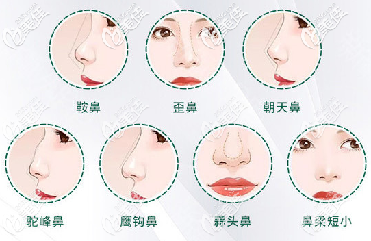 廣州星團(tuán)醫(yī)美蔡澤翔擅長(zhǎng)鼻綜合隆鼻 廣州星團(tuán)醫(yī)美蔡澤翔擅長(zhǎng)鼻綜合隆鼻