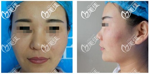 膨體隆鼻手術(shù)前 膨體隆鼻手術(shù)前