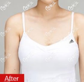 縮胸手術(shù)半年后效果