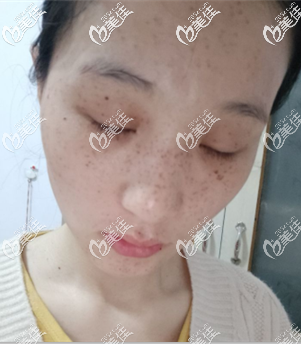 術前我臉上的斑 術前我臉上的斑