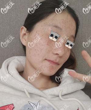 第二天結痂了 第二天結痂了