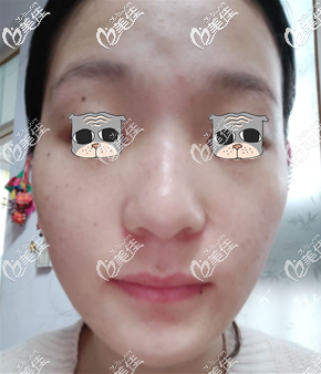 重慶華美皮秒祛斑術后10天圖片 重慶華美皮秒祛斑術后10天圖片