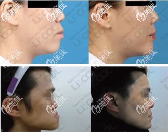 凸嘴地包天的人注射葡聚糖前后對比照片 凸嘴地包天的人注射葡聚糖前后對比照片