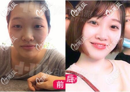 在雅美做雙眼皮術(shù)前術(shù)后對比照 在雅美做雙眼皮術(shù)前術(shù)后對比照