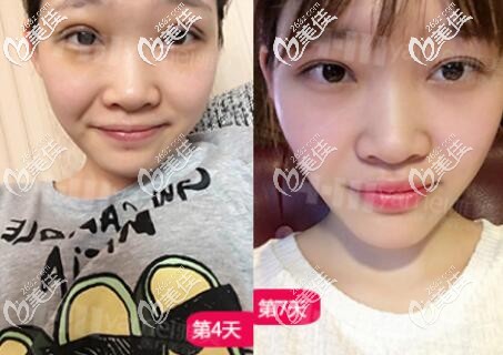 在長沙雅美做雙眼皮術(shù)后一周左右的效果照 在長沙雅美做雙眼皮術(shù)后一周左右的效果照