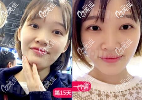 在長沙雅美做雙眼皮一個月左右恢復效果照 在長沙雅美做雙眼皮一個月左右恢復效果照