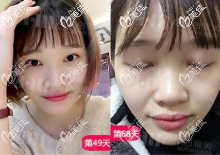 在雅美做雙眼皮2個月左右恢復效果圖 在雅美做雙眼皮2個月左右恢復效果圖