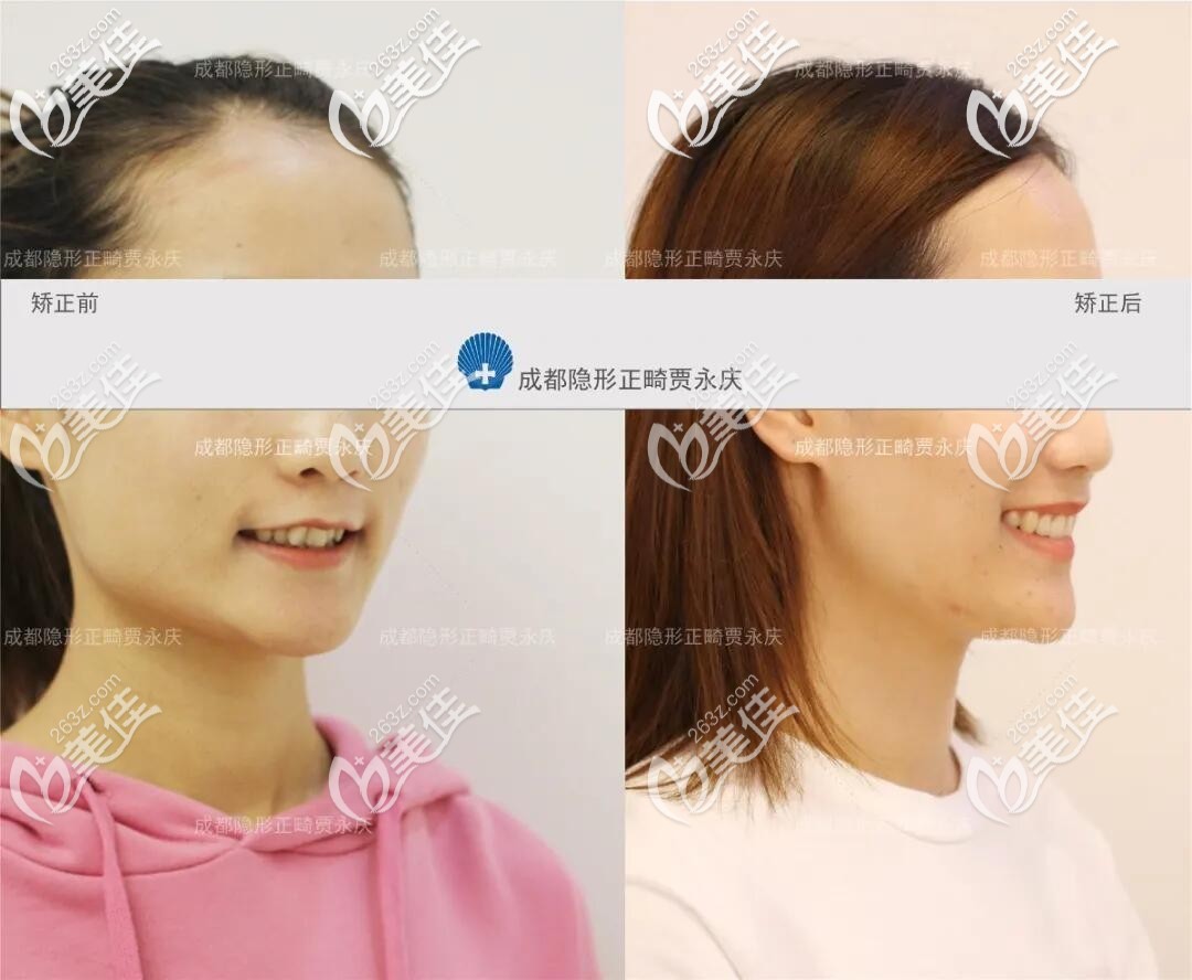 深覆合不拔牙能矯正嘴突嗎?快圍觀這波齙牙矯正不拔牙的案例吧