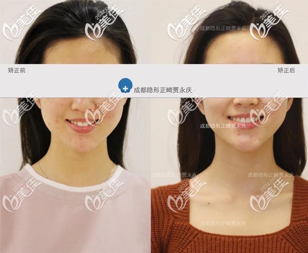 20歲矯正牙齒晚不晚 20歲矯正牙齒晚不晚