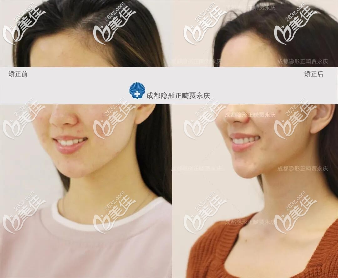 牙齒反合前后對(duì)比照 牙齒反合前后對(duì)比照