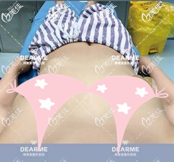 做假體隆胸前的情況 做假體隆胸前的情況