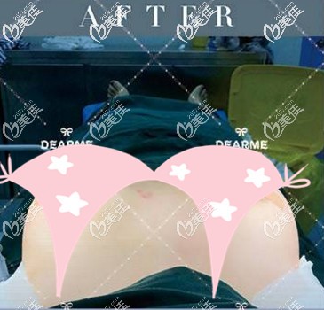 做藍(lán)貝假體豐胸后的即可效果 做藍(lán)貝假體豐胸后的即可效果