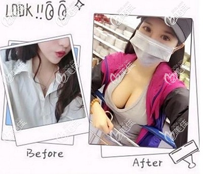 花一萬多做藍(lán)貝假體隆胸后我覺得術(shù)后效果和手感一點不比進(jìn)口曼托差