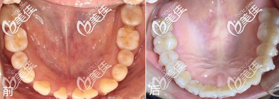 武漢大齡男青年稀疏牙齙牙隱適美整牙之旅,剛開始還覺得價格貴呢