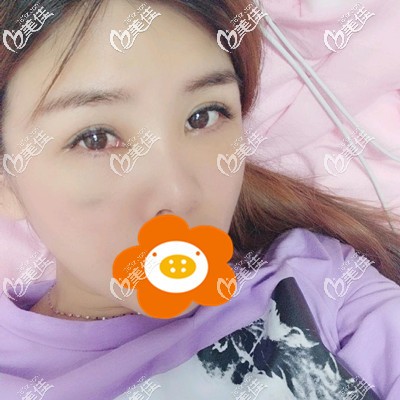 第5天看著消腫了很多 第5天看著消腫了很多