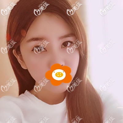 我的淚溝型眼袋在福州格萊美做了內切祛眼袋手術，今天分享恢復過程圖片