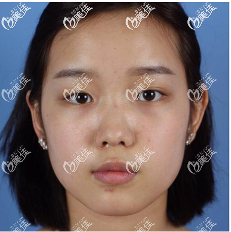 美萊鼻綜合怎么樣 美萊鼻綜合怎么樣