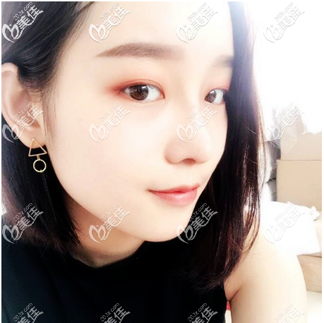廣州美萊做鼻綜合親身經(jīng)歷 廣州美萊做鼻綜合親身經(jīng)歷