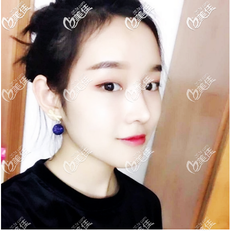 美萊鼻綜合怎么樣？分享我在廣州美萊做鼻綜合親身經(jīng)歷