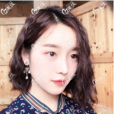 美萊鼻綜合術(shù)后兩個(gè)月 美萊鼻綜合術(shù)后兩個(gè)月