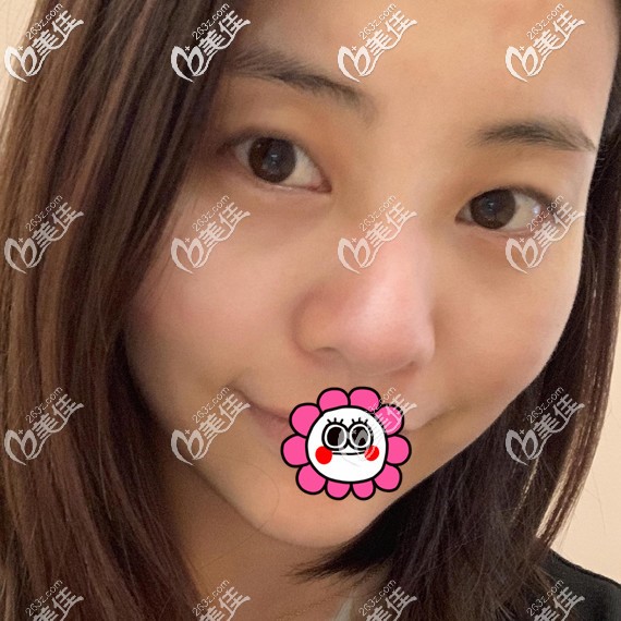 做雙眼皮隆鼻前 做雙眼皮隆鼻前