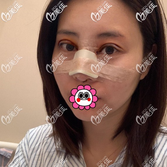 雙眼皮隆鼻術(shù)后即刻 雙眼皮隆鼻術(shù)后即刻