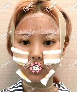 我在泰國(guó)曼谷雨季做完磨骨手術(shù)六天了