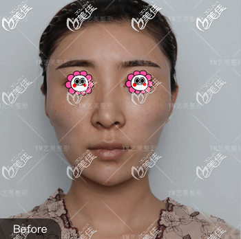 我做不開(kāi)刀一針降顴弓手術(shù)前 我做不開(kāi)刀一針降顴弓手術(shù)前