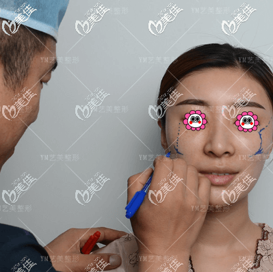 王東給我做一針降顴弓手術(shù)設(shè)計(jì)時(shí) 王東給我做一針降顴弓手術(shù)設(shè)計(jì)時(shí)