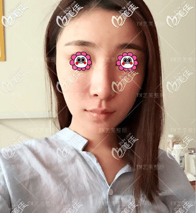 我做一針降顴弓第12天你覺(jué)得效果到底好么 我做一針降顴弓第12天你覺(jué)得效果到底好么