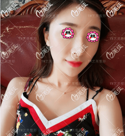 北京藝美王東不開(kāi)刀一針降顴弓案例效果圖 北京藝美王東不開(kāi)刀一針降顴弓案例效果圖