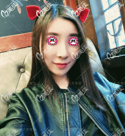 一針降顴骨哪家醫(yī)院好?北京藝美王東給我做一針降顴弓案例效果圖好友看完說挺好