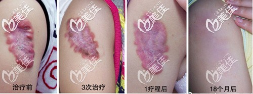 成都軍大整形外科醫(yī)院 張家龍術(shù)前照片1