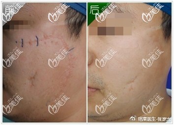 去疤效果怎么樣?這些多維祛疤療法淡化疤痕真實案例給你實錘證據(jù)