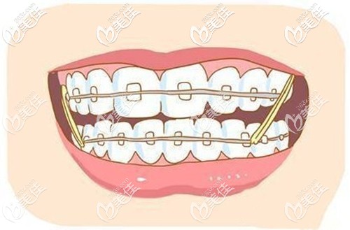 常德美奧口腔傳統(tǒng)金屬托槽 常德美奧口腔傳統(tǒng)金屬托槽