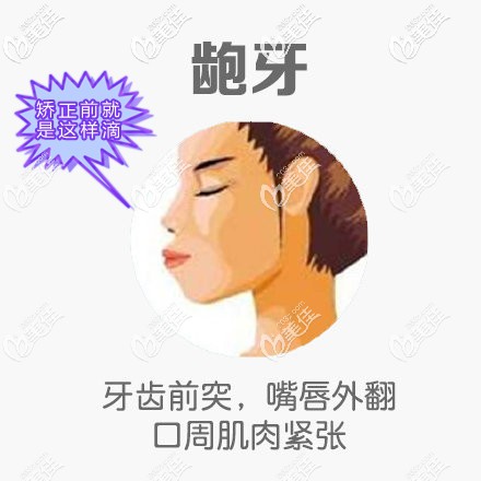 我在常德美奧口腔做齙牙矯正前的照片 我在常德美奧口腔做齙牙矯正前的照片