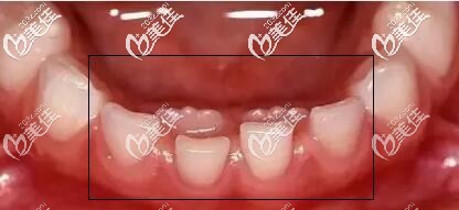 雙排牙 雙排牙