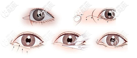 深圳潤澤瑞尼絲何海飛醫(yī)生雙眼皮手術(shù)過程圖 深圳潤澤瑞尼絲何海飛醫(yī)生雙眼皮手術(shù)過程圖