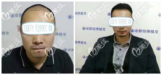 成都恒博胡須種植+發(fā)際線種植效果圖