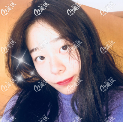 找廣州美萊劉志坤做雙眼皮術前照片