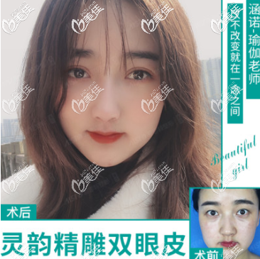 重慶愛思特盧美均雙眼皮